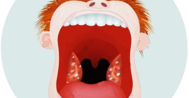 Prichiny-belyh-pyaten-na-gorle-i-metody-ih-lecheniya
